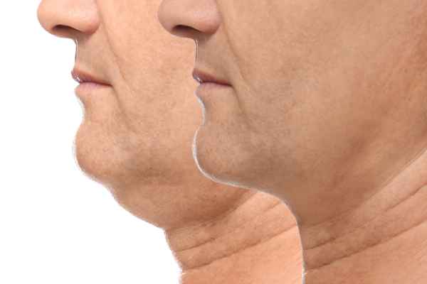 HIFU - Breakthrough in Anti - ageing 2 hifu results Cirencester