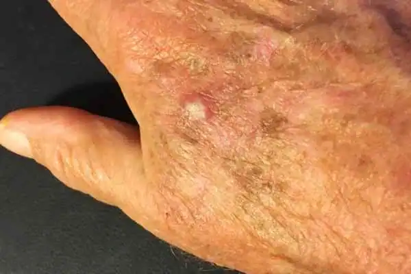 Image of Actinic keratoses Cirencester on a person hand
