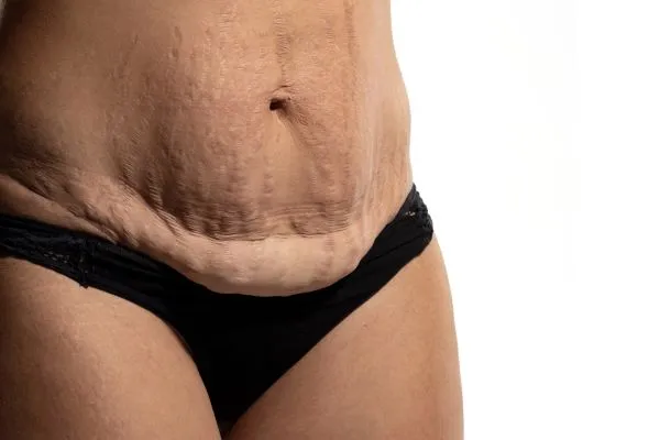The science behind skin tightening Cirencester picture of a woman's sagging skin on the stomach